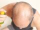 Hair Restoration Options Before Considering A Hair Transplant